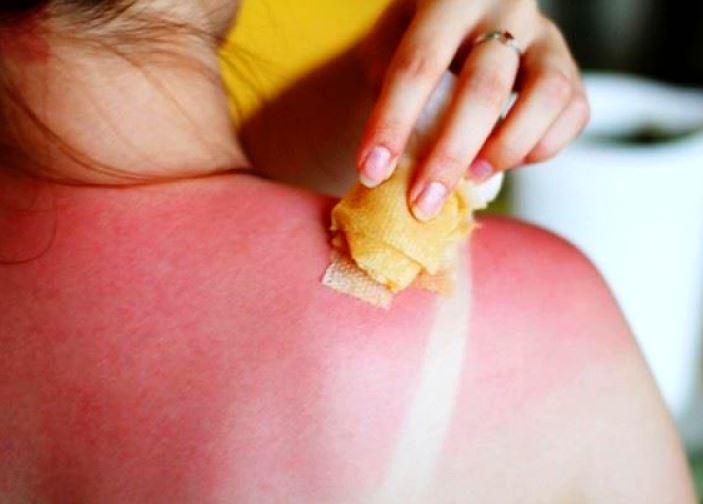Tamponarea pielii inrosite in urma arsurilor solare.